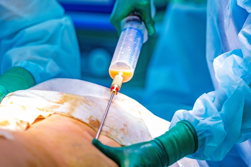 What Instrument is Used for Liposuction?
