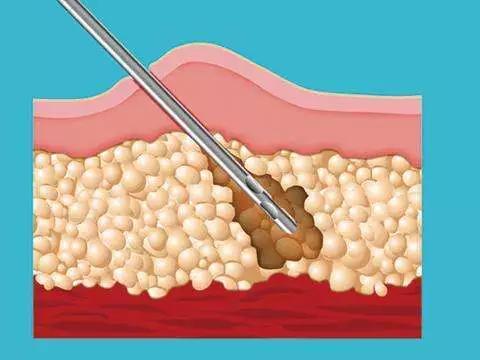 FAQ of liposuction surgery