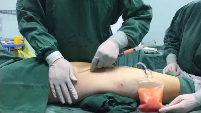 Liposuction was performed using a one-way valve.